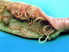 De oorzaken van parasieten in het menselijk lichaam