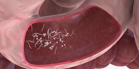 Het gebruik van drieling om parasieten te verwijderen