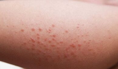 externe manifestaties van de aanwezigheid van parasieten in het lichaam