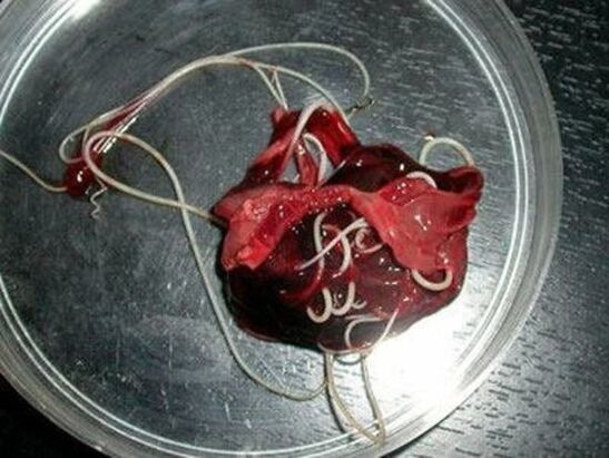 wormen uit het menselijk lichaam